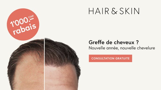 Profite maintenant pour une courte durée d'un rabais de CHF 1'000 sur ta greffe de cheveux !