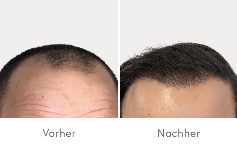 Beeindruckende Ergebnisse nach der Haartransplantation bei HAIR & SKIN.