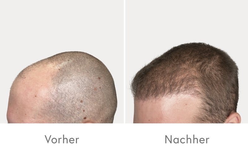 Beeindruckende Ergebnisse nach der Haartransplantation bei HAIR & SKIN.