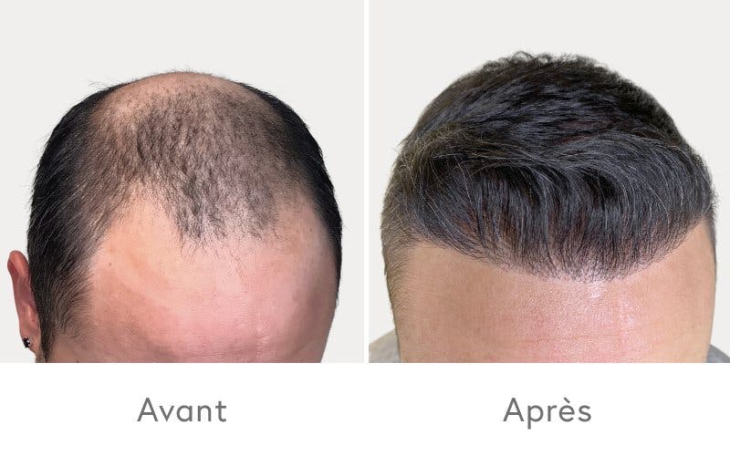 Des résultats impressionnants après une greffe de cheveux chez HAIR & SKIN.