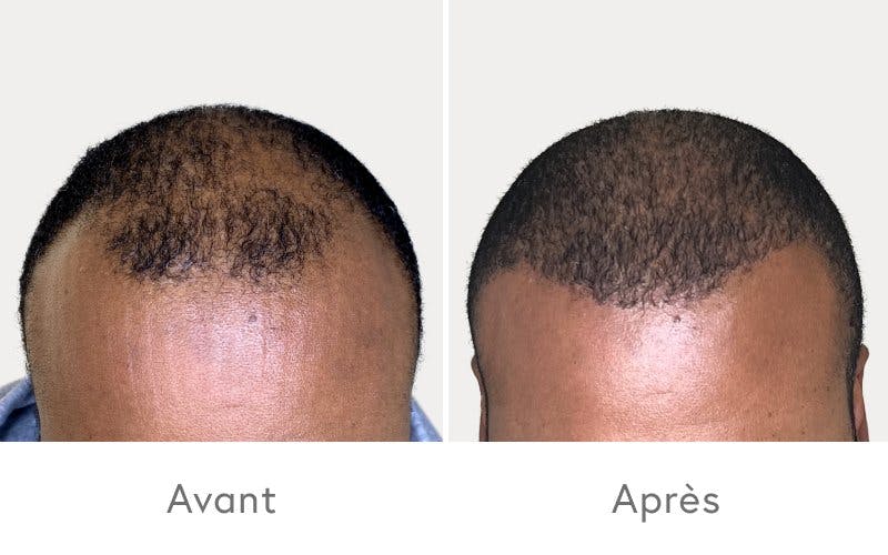 La chute des cheveux touche beaucoup d'hommes, mais il existe des solutions.