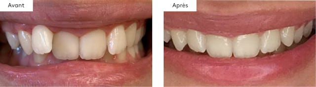 20 aligneurs, 10 mois de traitement.
