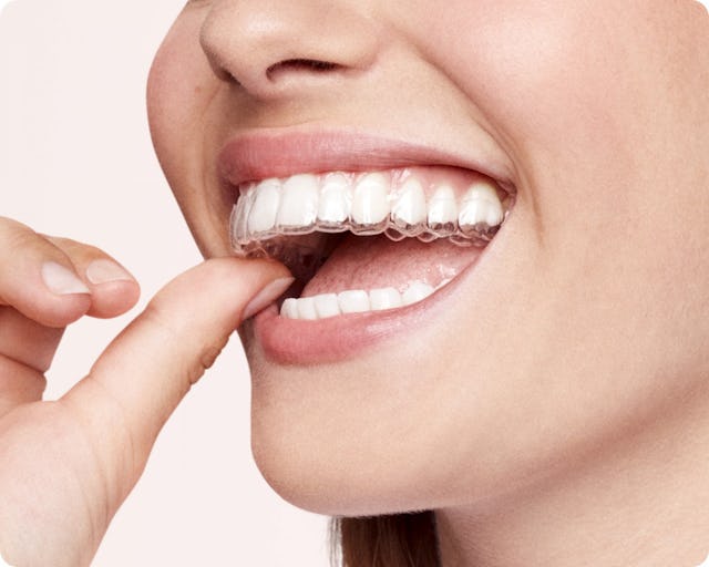 Les aligneurs bestsmile Night Aligner corrigent les dents dans la position souhaitée pendant la nuit.