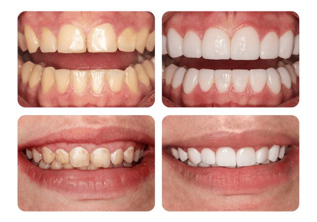 Der Vergleich zeigt, wie viel weisse Zähne ausmachen.