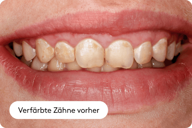 Verfärbungen durch Unfälle und Verletzungen