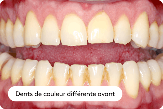 Teinte naturelle des dents