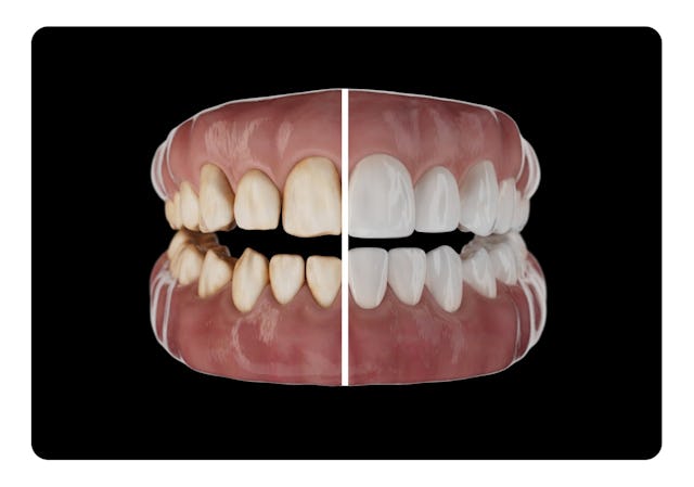 Les facettes Veneers sont des coques en céramique très fines qui sont placées sur les dents pour créer un sourire harmonieux.