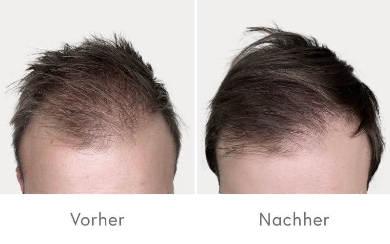 Erstaunliche Resultate bereits nach 4 bis 8 PRP-Behandlungen