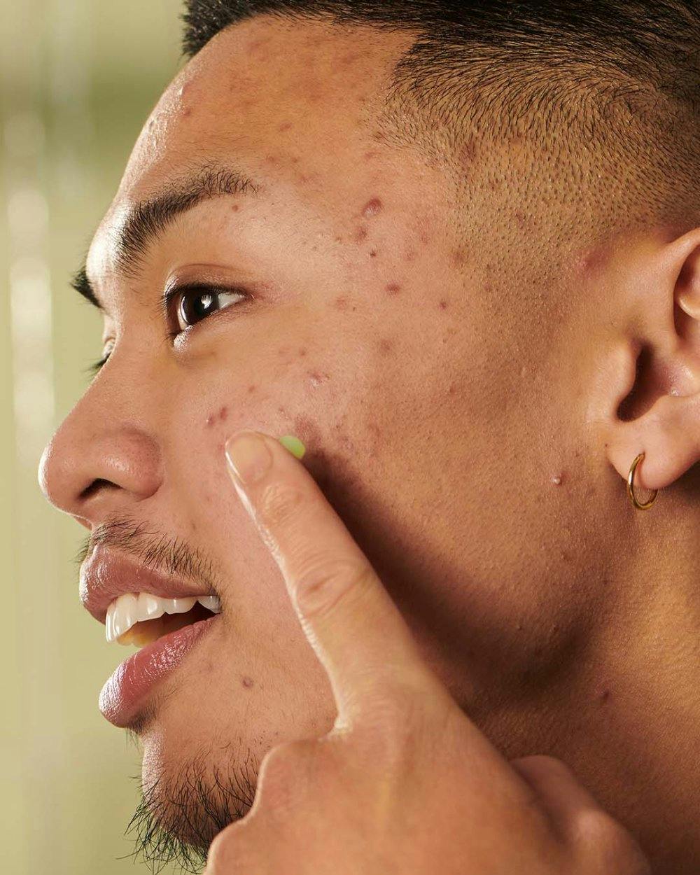 Teebaumöl wirkt Pickeln und Unreinheiten entgegen.