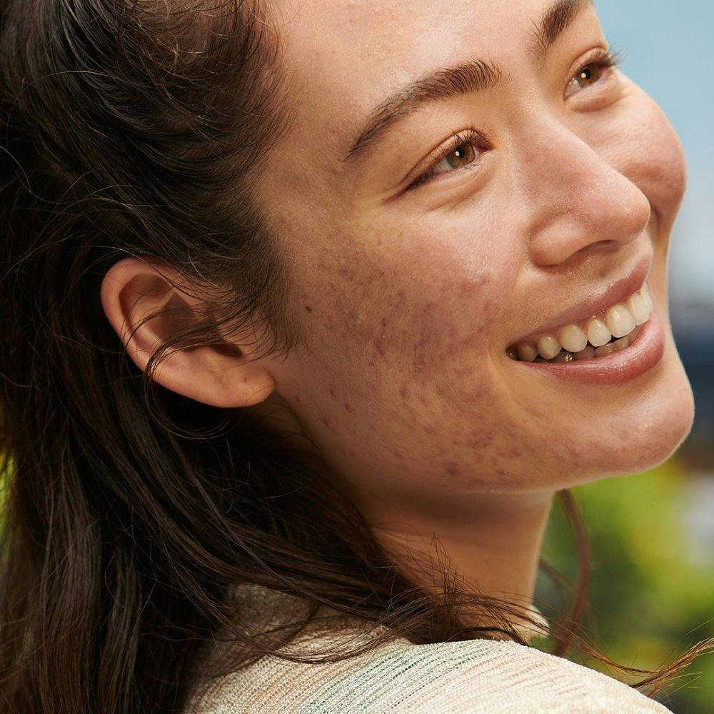 Auch bei Akne kann Teebaumöl Wunder wirken.