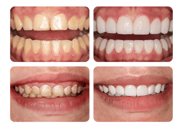 Les dents blanches sont précieuses!