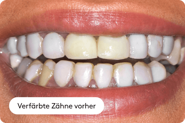 Verfärbungen durch Zigaretten