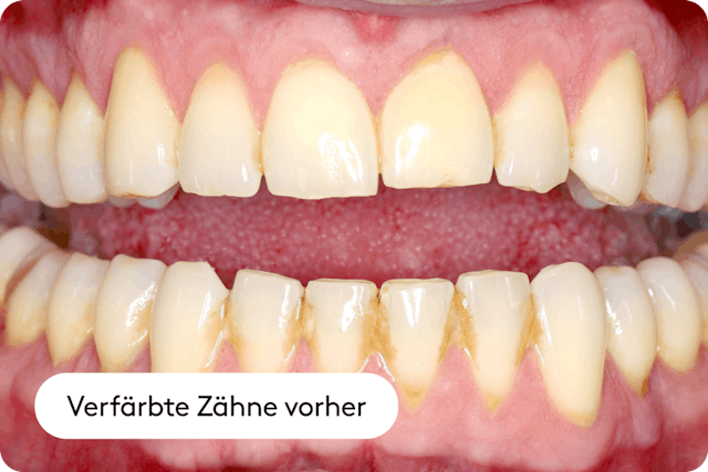 Natürliche Zahnfarbe