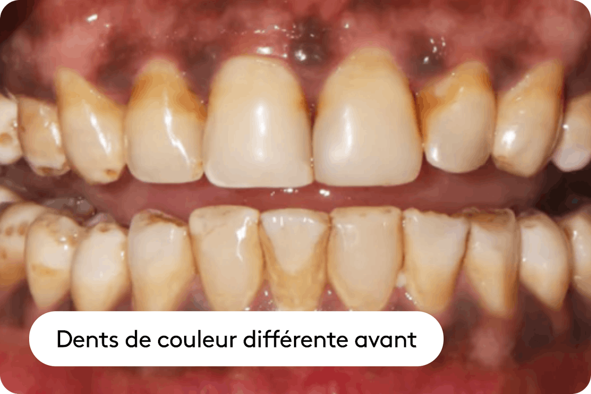 Décoloration due aux aliments