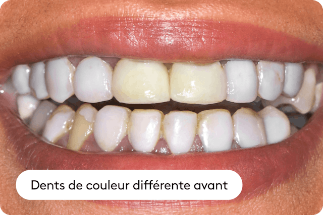 Décoloration due aux cigarettes