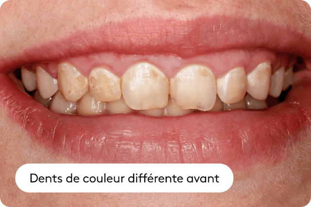 Décoloration due aux accidents et blessures