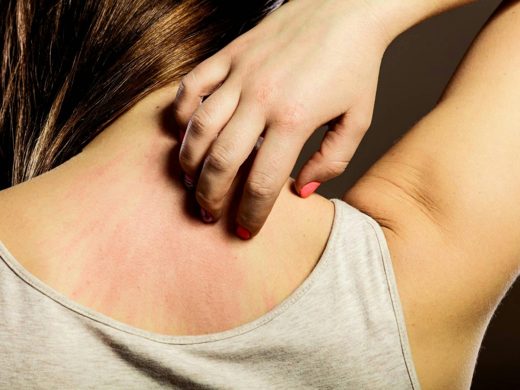 Kratzen verboten: Der Juckreiz ist ein Teil des Heilungsprozesses.