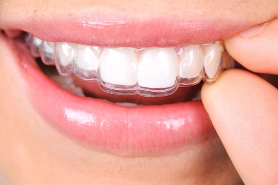 1. Schnell, einfach & unauffällig