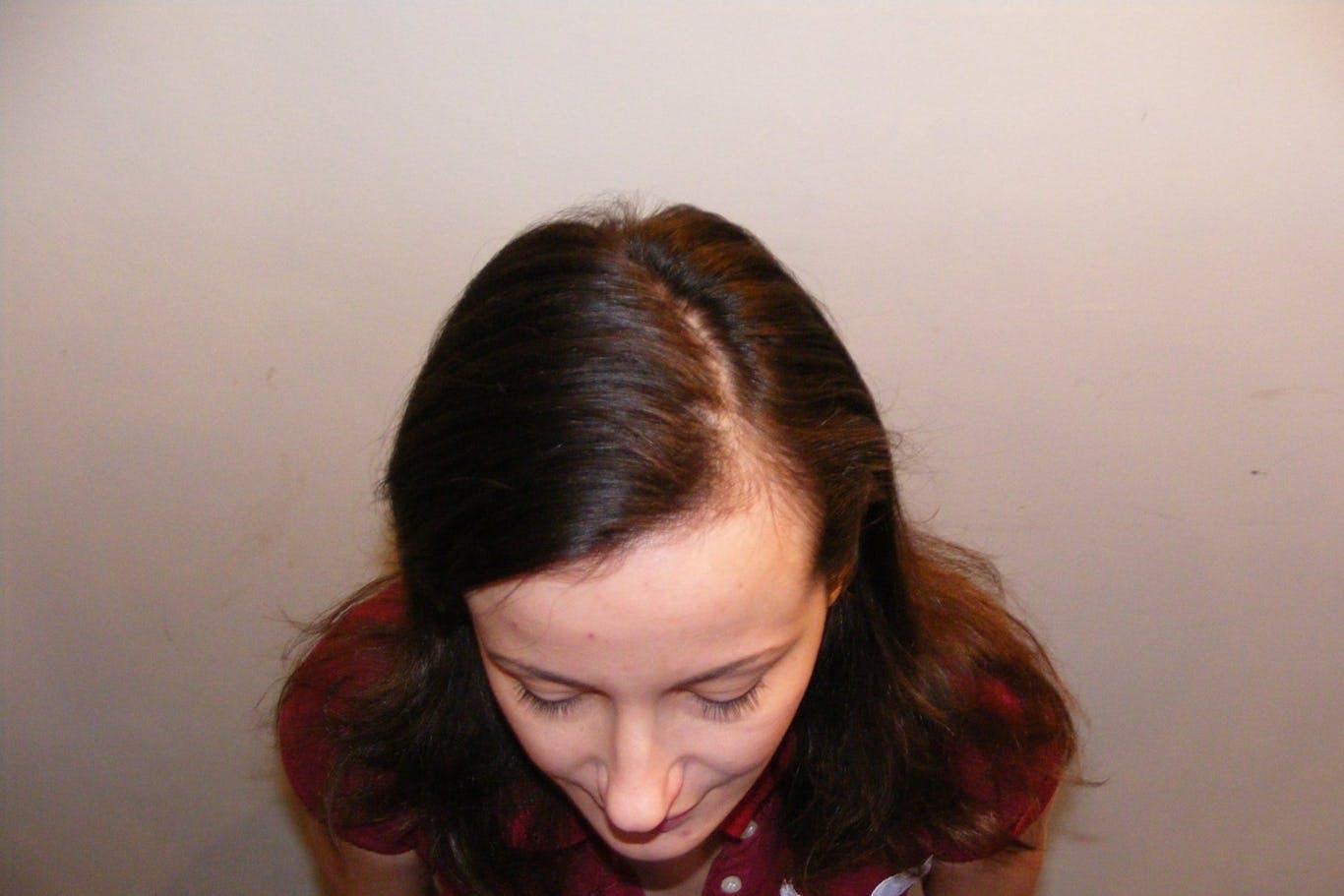 Vorher: die betroffenen, lichten Kopfstellen.