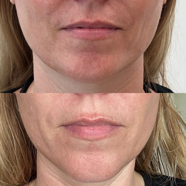 Dr. Sascha Dunst weiss: «Oft führen Kombinationsbehandlungen zum maximalen Erfolg. Hier die Konturierung von Kinn und Kieferlinie mit Fadenlift und die sanfte Betonung der Lippen mit Hyaluronfiller.»