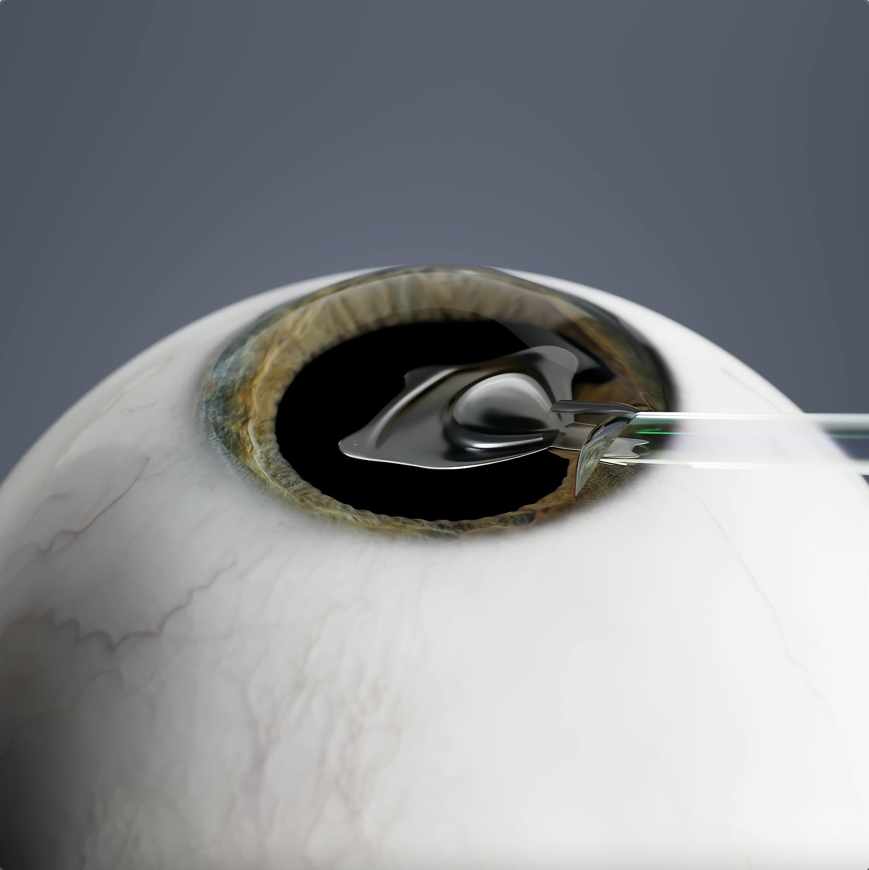 Une fois que le cristallin autologue a été retiré, la lentille artificielle est mise en place.