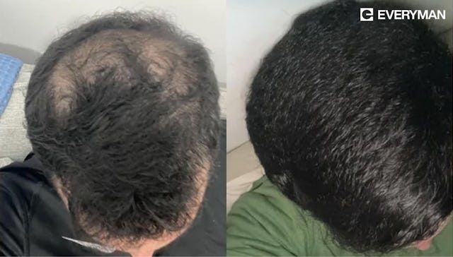4 von 5 Männer sehen eine deutliche Verbesserung ihres Haarwachstums 4 von 5 Männer sehen eine deutliche Verbesserung ihres Haarwachstums