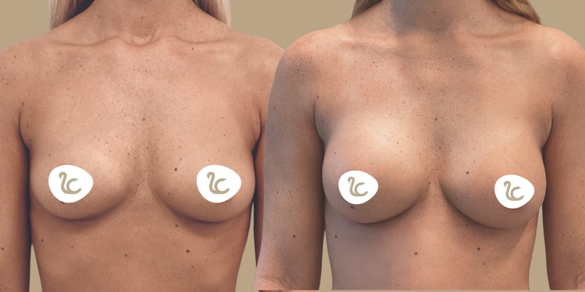 Vorher/Nachher Resultat einer Brustvergrösserung mit Mia Femtech™