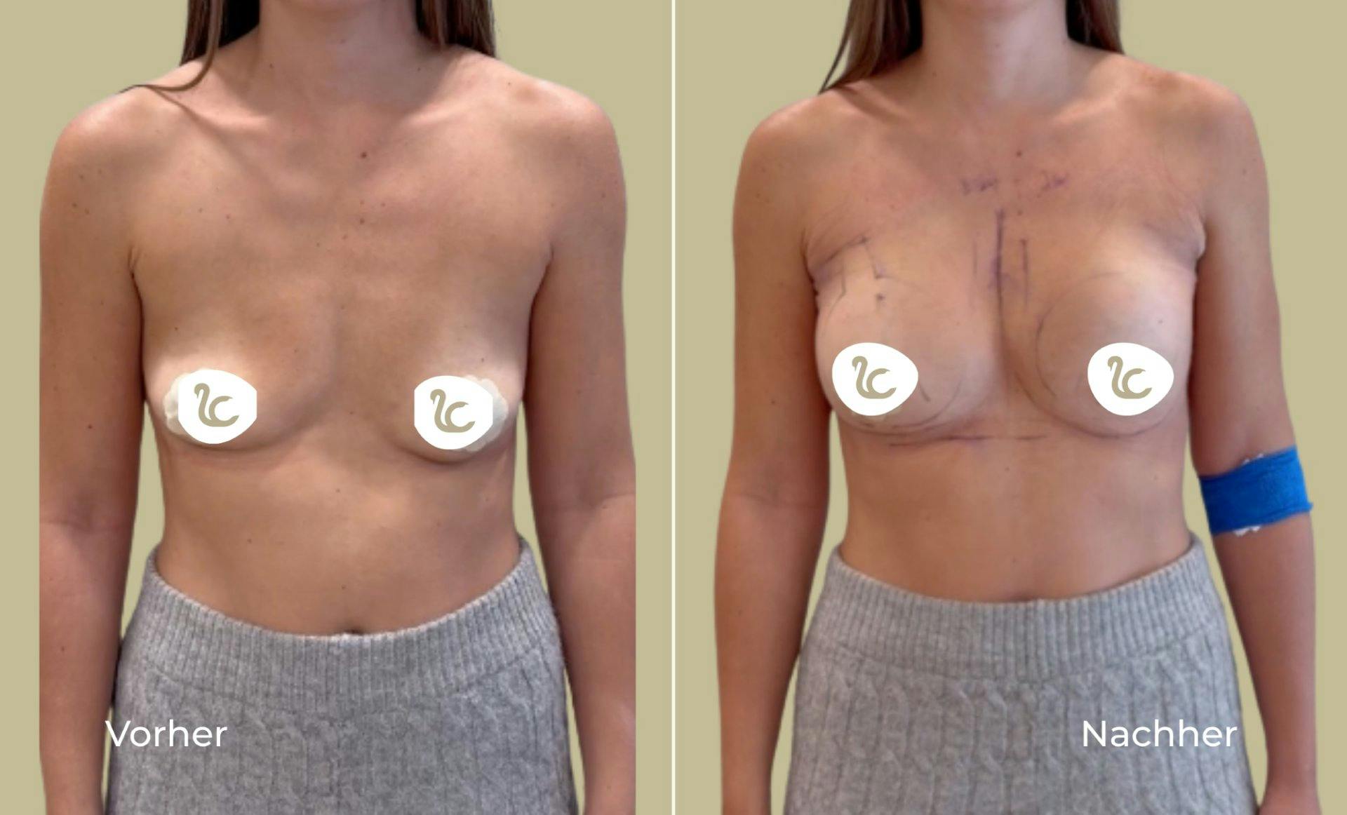 Durch die minimalinvasive Methode mittels Injektion der Implantate über die Achsel bleibt die Brust komplett narbenfrei.