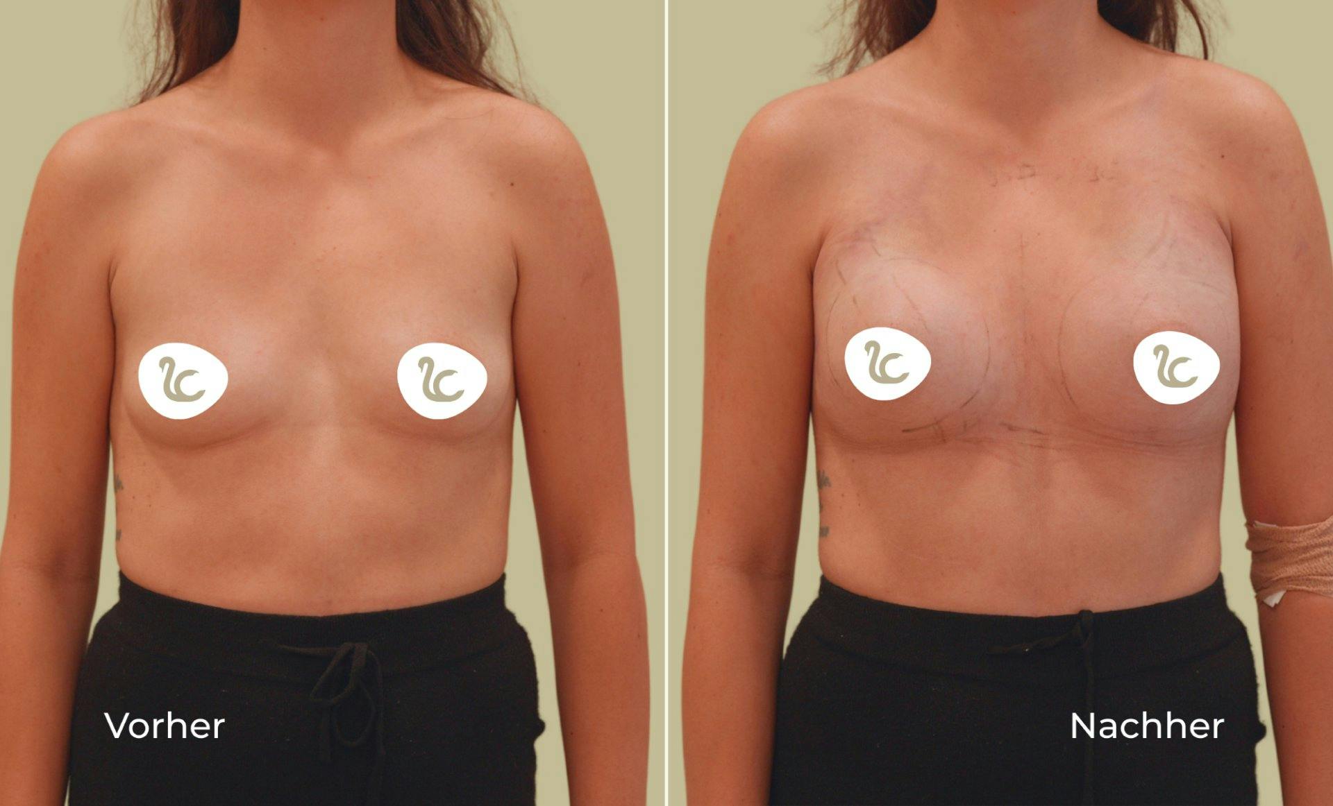 Lauras Vorher-Nachher-Vergleich: Brustvergrösserung mit Mia Femtech™.