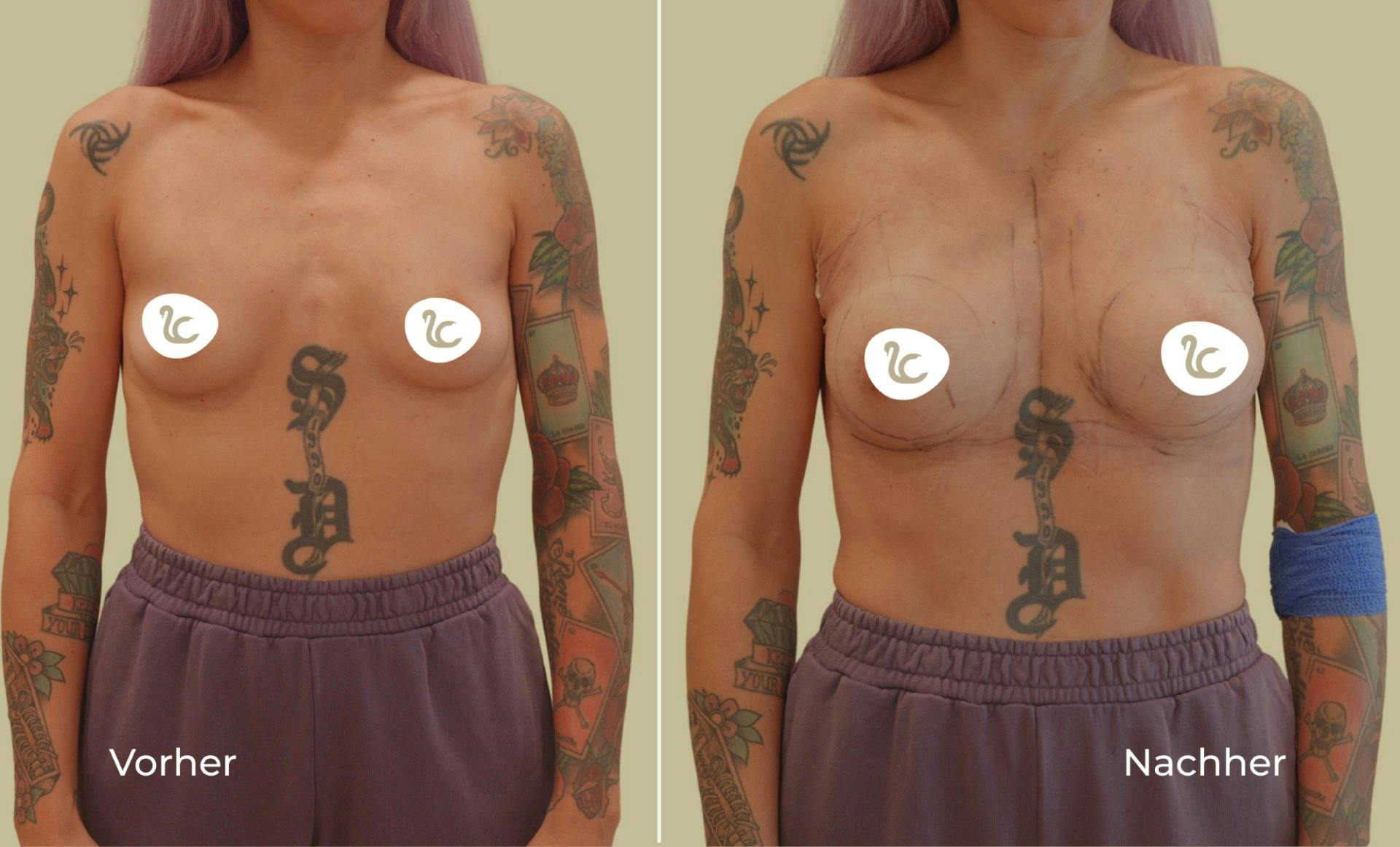 Diese Patientin der Lucerne Clinic wünschte sich etwas mehr Fülle, keine auffällige Vergrösserung. Vorher-Nachher-Vergleich direkt nach der Operation.