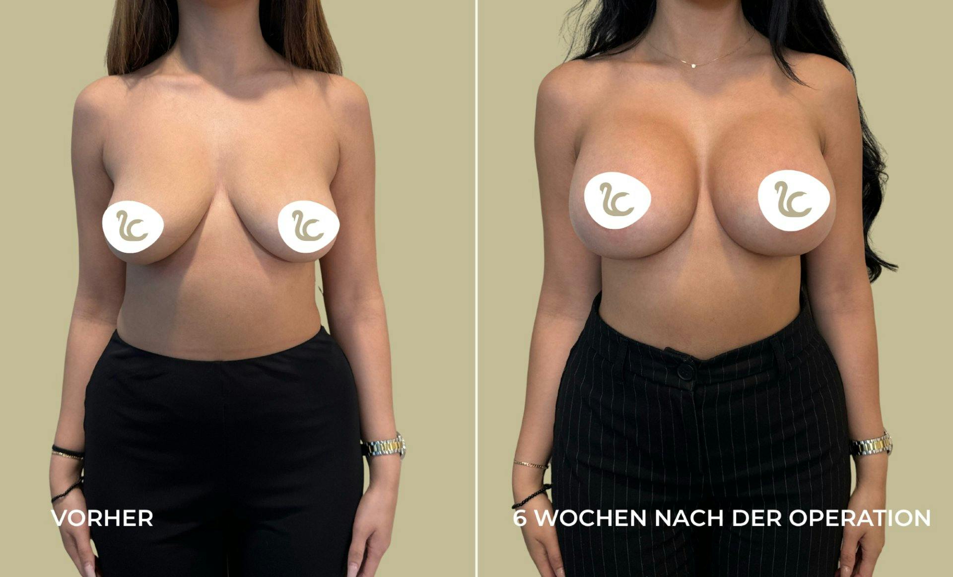 Vorher-Nachher-Vergleich einer Patientin der Lucerne Clinic.