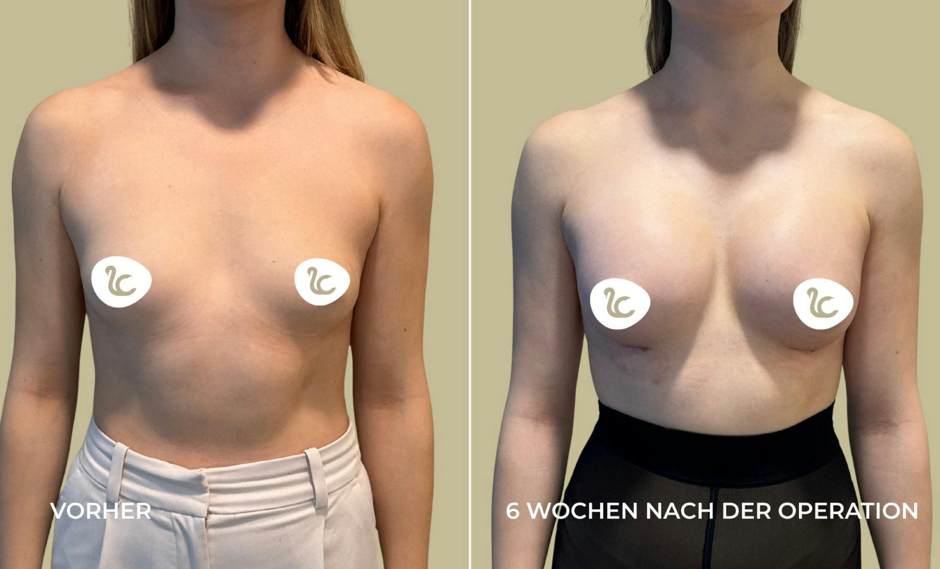 Sanfte Brustvergrösserung mit Silikon. Zu sehen: Vorher-Nachher-Vergleich einer Patientin der Lucerne Clinic.