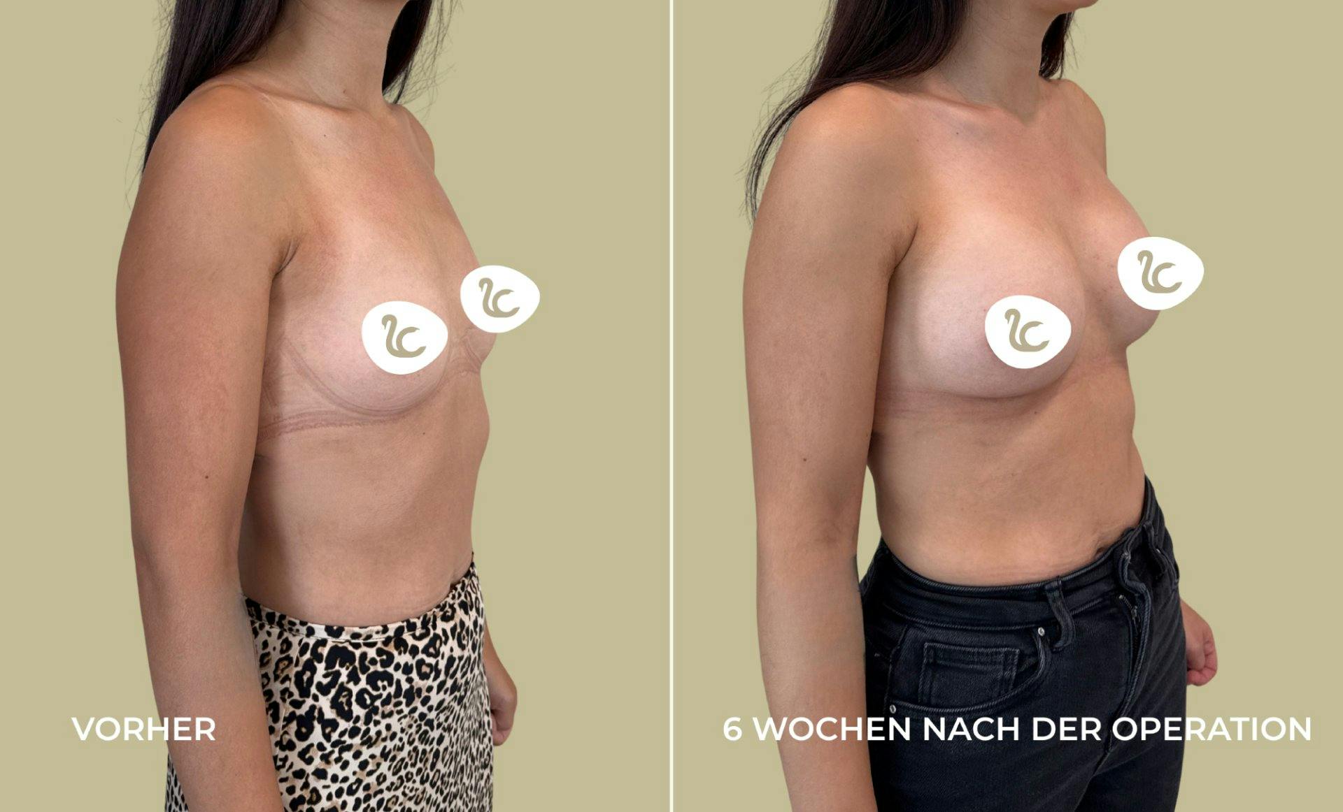 Vorher-Nachher-Vergleich einer Patientin der Lucerne Clinic.