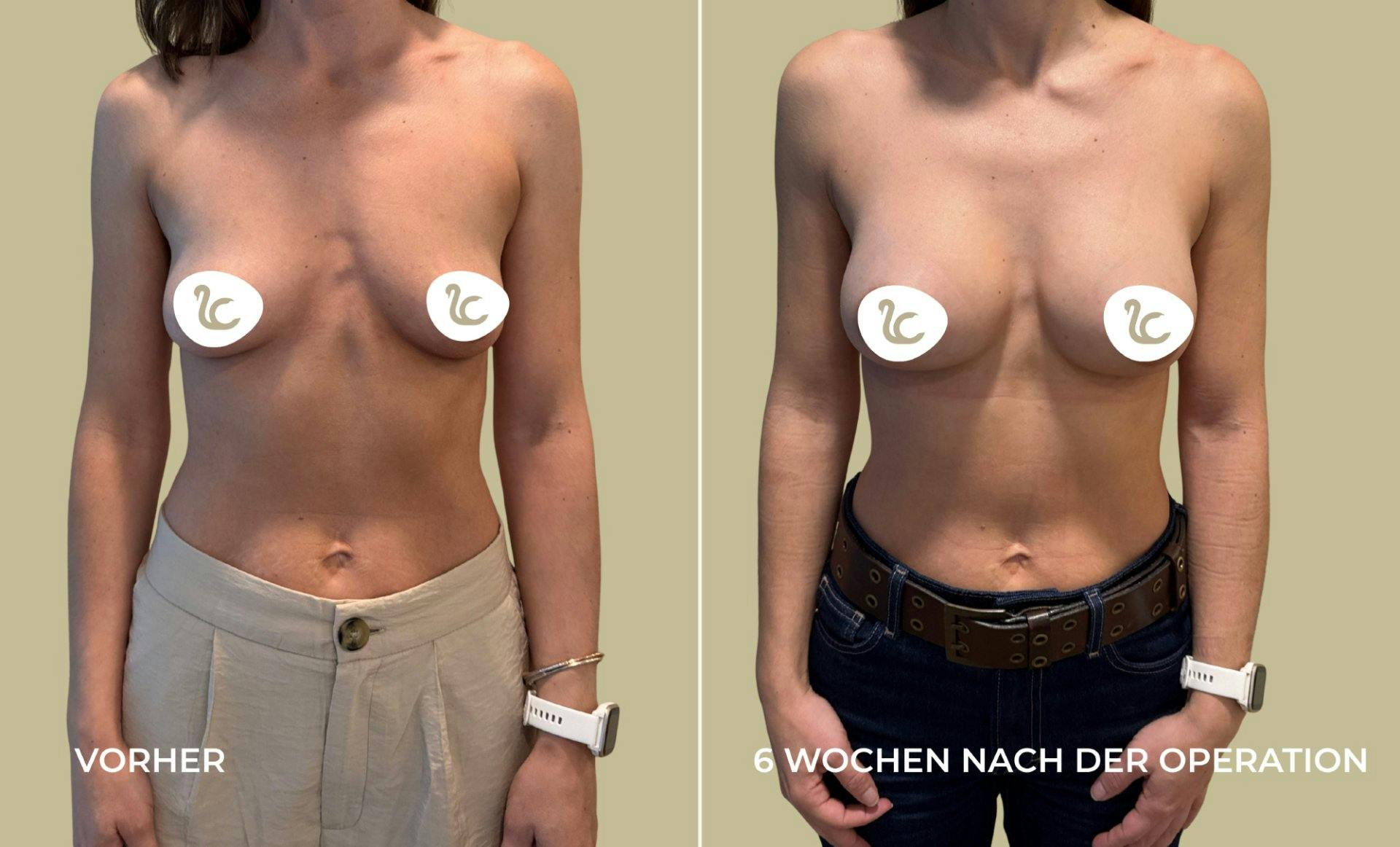 Dank der revolutionären Schnitttechnik der Chirurgen der Lucerne Clinic ist der Schnitt in der Brustfalte nur etwa 2.5 Zentimeter lang und auf Dauer s...