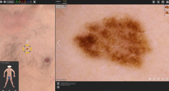 Der Hautscanner erkennt innert kürzester Zeit kleinste Muttermale am Körper und kann verdächte Stellen ausfindig machen.