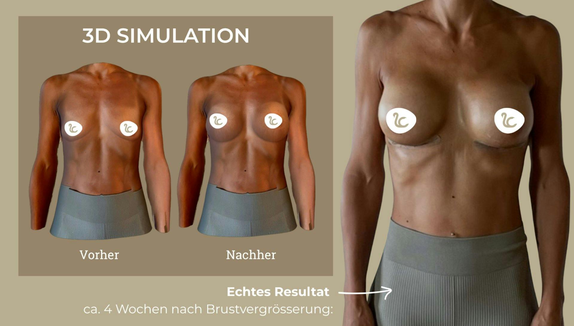 Durch die 3D-Simulation kannst du deine Brust mit verschiedenen Grössen visualisieren. In einem kostenlosen Videoanruf mit einer Fachperson erhältst d...