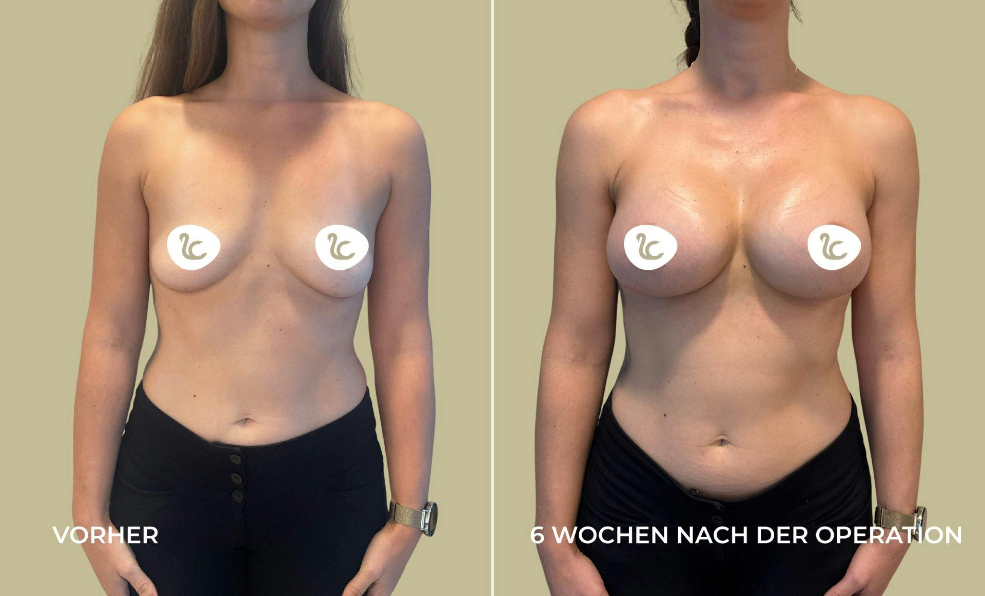 «Ich hätte es schon früher wagen sollen» , sagt eine Patientin der Lucerne Clinic. Zu sehen: Ihr Vorher-Nachher-Vergleich.