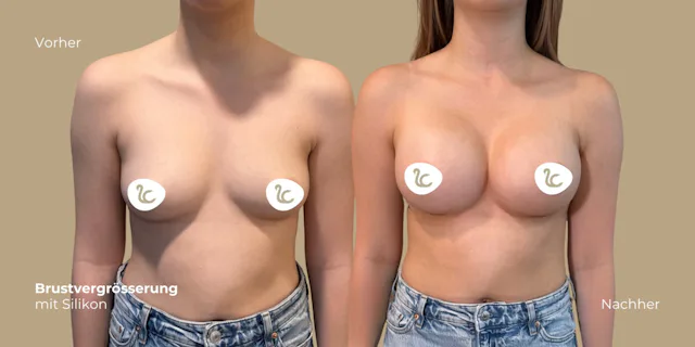 Vorher (links) und Nachher (rechts) Resultat einer Patientin der Lucerne Clinic nach ihrer Brustvergrösserung mit Silikon, sechs Wochen nach der Operation.