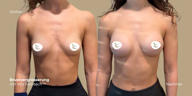 Vorher (links) und Nachher (rechts) Resultat einer Patientin der Lucerne Clinic nach ihrer Brustvergrösserung mit Mia Femtech™ acht Wochen nach der Operation.