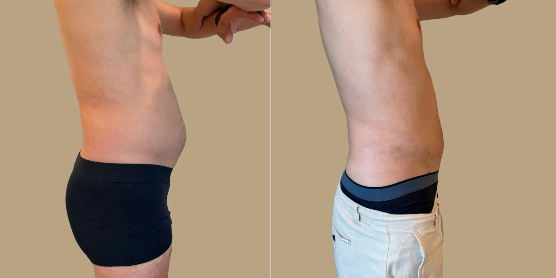 Vorher (Li) / Nachher (Re) Resultat der Lucerne Clinic einer Liposuktion an Bauch und Flanken