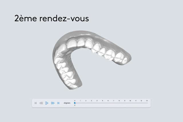 Lors de ton deuxième rendez-vous, le dentiste discute avec toi de ton plan de traitement personnalisé. Avant même d’effectuer ton traitement, tu pourras voir à quoi va ressembler la correction de tes dents grâce une animation 3D.