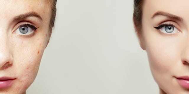 Unreine Haut muss nicht sein: Vor- und nach einer Behandlung. Unreine Haut muss nicht sein: Vor- und nach einer Behandlung.