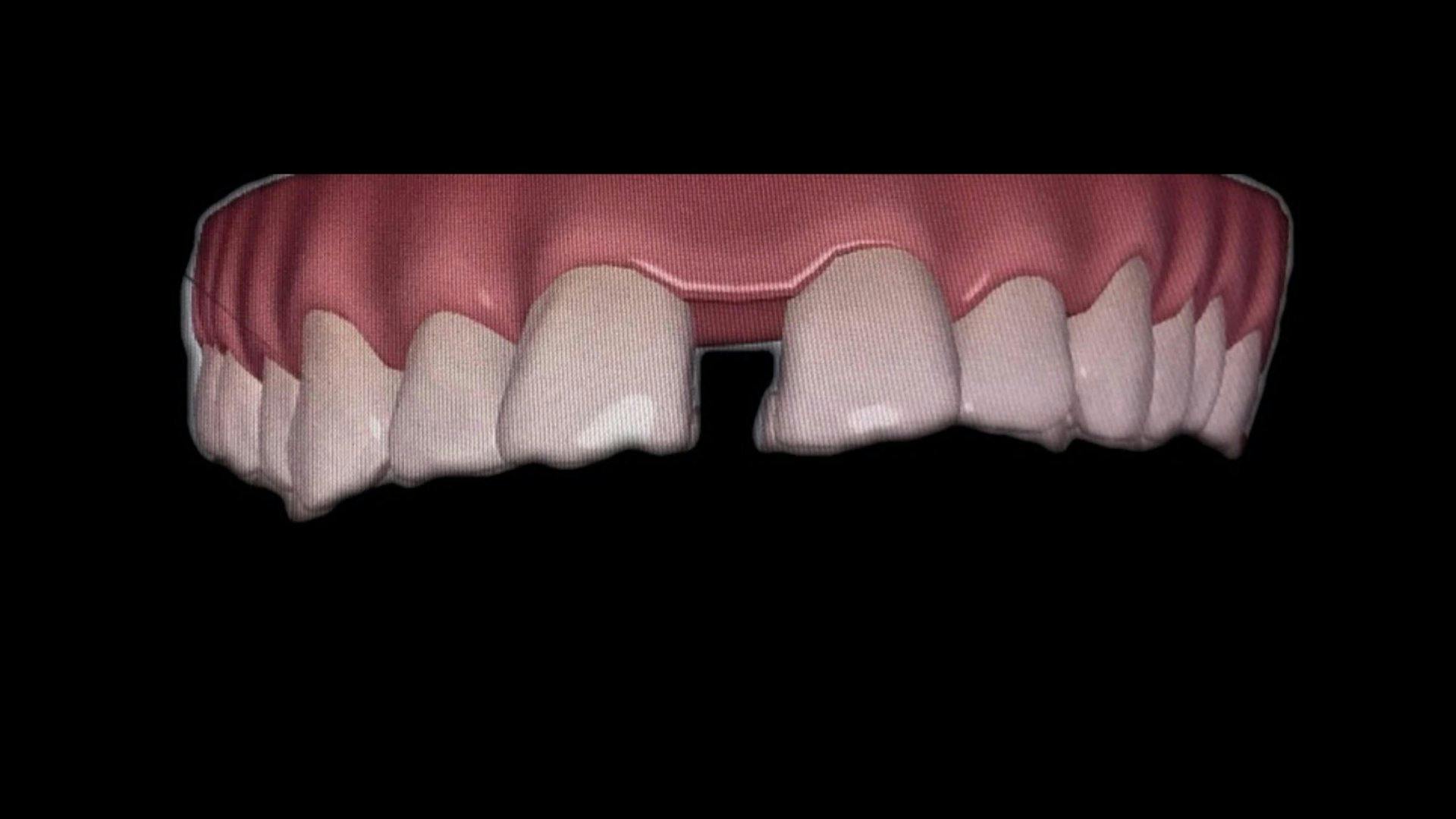 Vorher: Wenn die Lücke stört, kann die ACC am Claraplatz Zahnklinik auch das beheben.