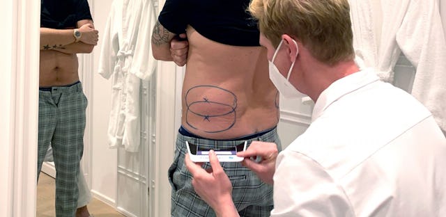 Intensive Kälte lässt Fettzellen in der Unterhaut kristallisieren: Der Arzt markiert die Problemzonen.