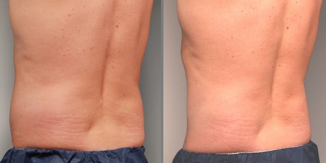 Michaels «Love Handles» haben sich durch die CoolSculpting-Behandlung (2 Zyklen pro Körperseite) deutlich reduziert.