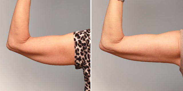 Oberarme vor und nach einer CoolSculpting Behandlung.