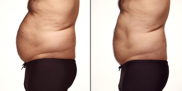 Deutliche Fettreduktion am Bauch durch eine Behandlung.