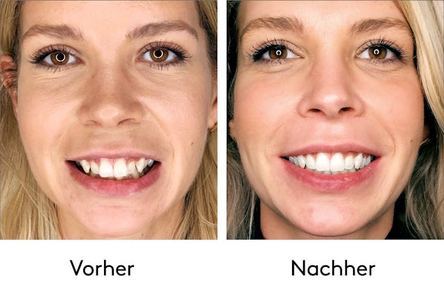 Gerade Zähne in kurzer Zeit? Das geht mit der bestsmile Praxis und ihrer durchsichtigen Zahnspange.