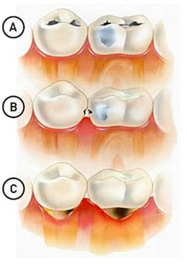 Die Karies (im Volksmund auch ganz einfach „ein Loch“ genannt) entsteht, wenn die Säure, welche von der Plaque (Bakterien & Zucker) produziert wird, den Zahn auflöst. Der wirksamste Schutz gegen Karies ist das Zähneputzen mit fluorhaltigen Produkten. Während der Sprechstunde teilen wir Ihnen gerne mit, welche Produkte für Ihre Zähne am am besten geeignet sind.
