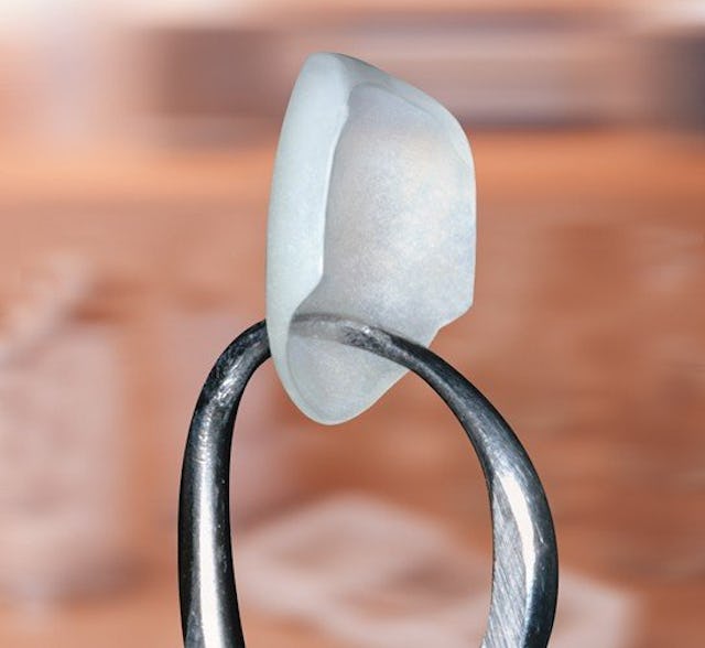 Der Einsatz von Lumineers (hauchdünne Keramikschalen) ist oft ohne Beschleifen der Zähne möglich. 